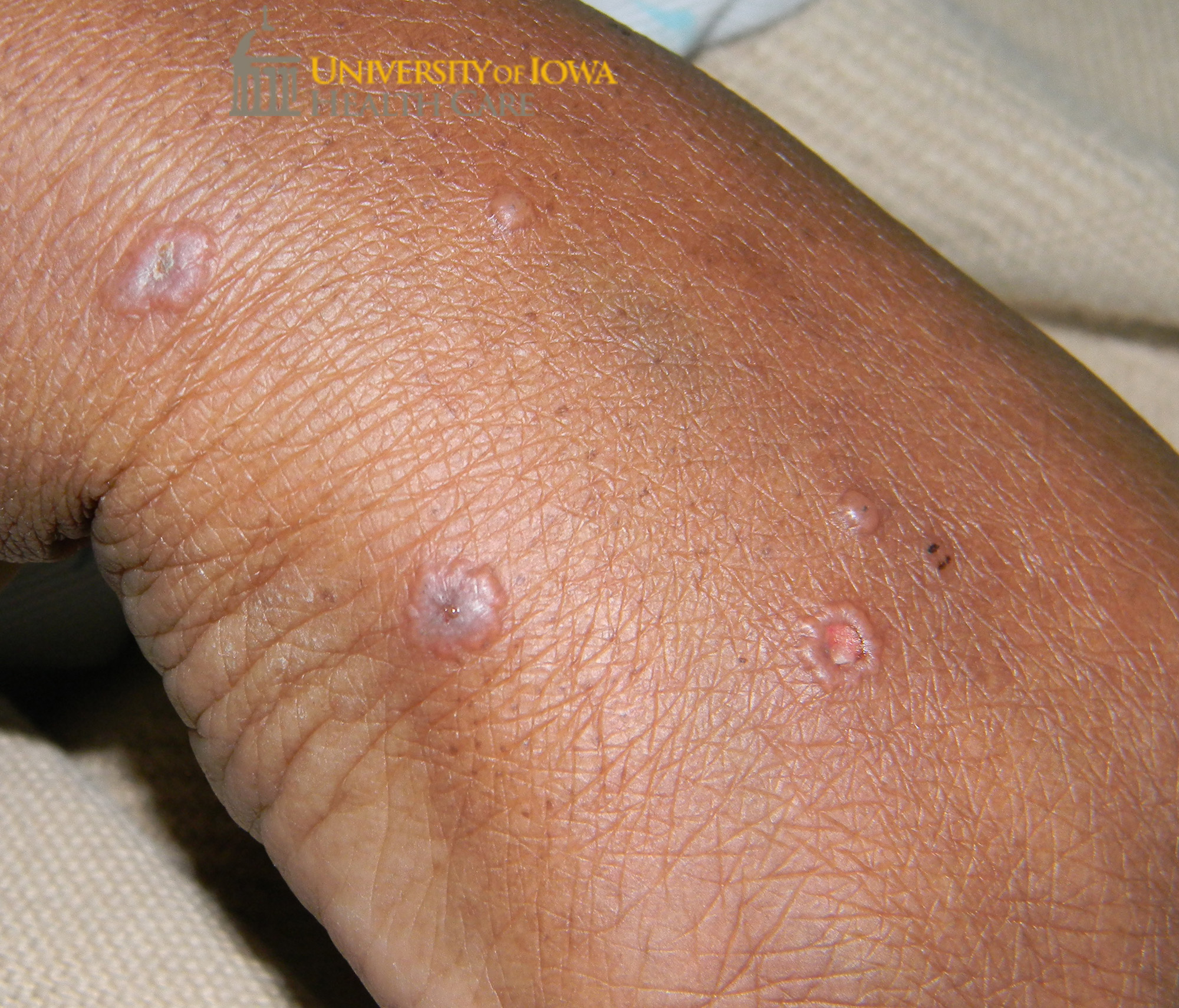 Many pink papules and vesicles, some with central erosion and umbilication . (click images for higher resolution).